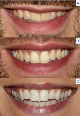 Figura 10. Largura do sorriso com exposição ao  primeiro pré-molar (a), segundo pré-molar (b) e  primeiro molar (c)