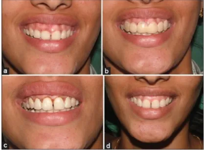 Figura 12. a) Sorriso pré-operatório, b) com prótese acrílica, c)excisão com laser  de díodo, d) sorriso pós-operatório após um mês  (Narayanan et al., 2015)