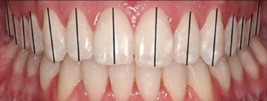 Figura 13. Posicionamento recomendado do zénite em relação ao longo eixo dos dentes  maxilares anteriores
