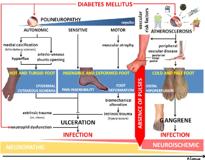 Figure A1-4 – Diabetic foot infection pathophysiology. Diabetic foot ulcer results from the complex  interaction  of  a  number  of  risk  factors