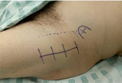 Figure 1 – The skin incision used to the DAA to THA. 