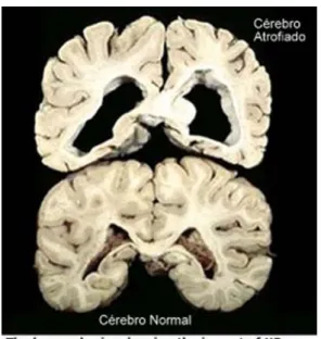 Figura 04 – Comparação Cérebro Sadio X Acometido pela DH. 