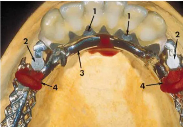 Figura  5:  Prótese  fixa  implanto-suportada  com  a  estrutura  metálica  da  prótese  parcial  removível  adaptada  e  capturada  com  resina  autopolimerizante