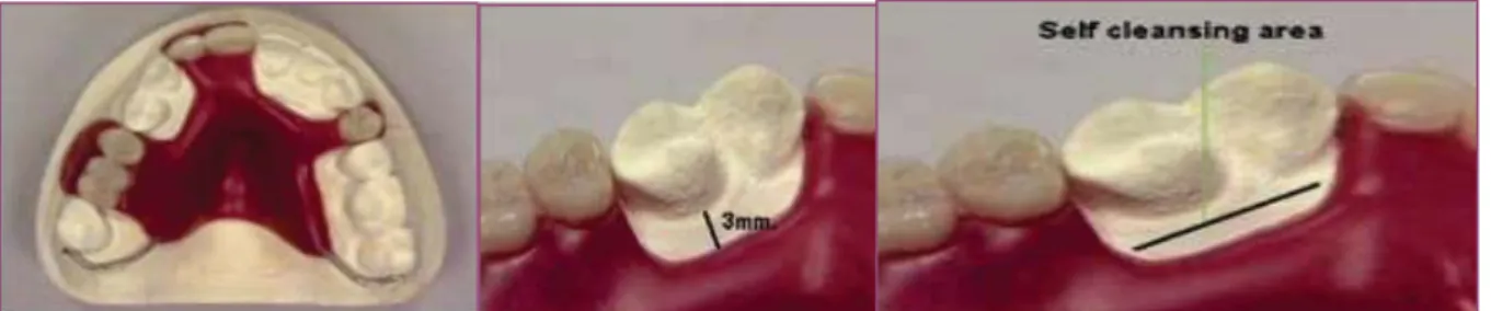 Figura 5- (Every denture com grampos na superfície distal localizados no dente natural mais  distal- ajudam a prevenir movimento anterior da base da prótese e os movimentos dos dentes  naturais/ áreas de alívio gengival-mínimo de liberação de 3mm é satisfa