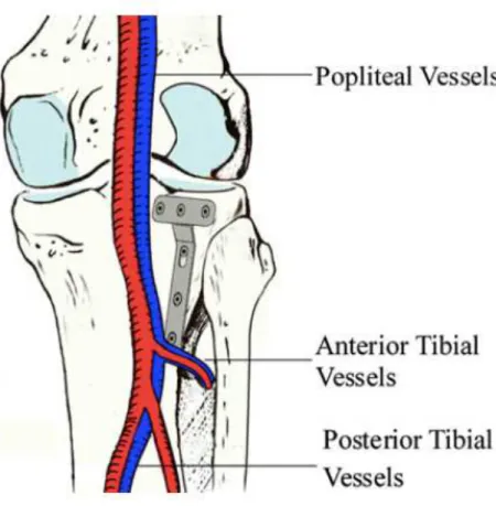 Figura 1: Ilustração mostrando a relação entre os vasos poplíteos e a placa colocada na região  póstero-lateral do planalto tibial