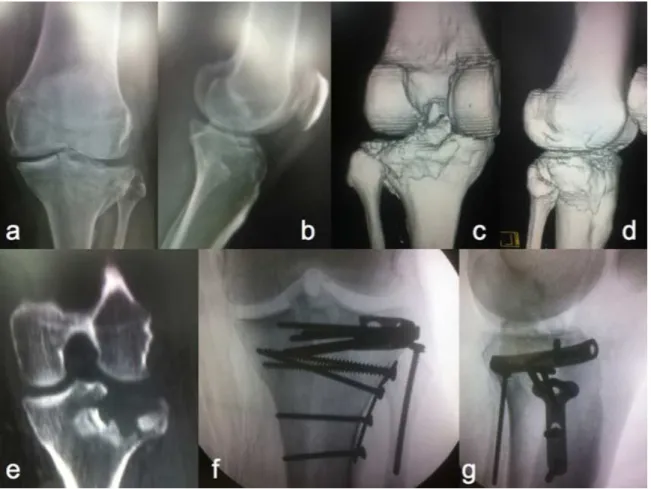 Figura 10: A e B: Radiografias do joelho em ântero-posterior e perfil de um paciente do  gênero masculino, 42 anos, que apresentou fratura do planalto tibial Schatzker II