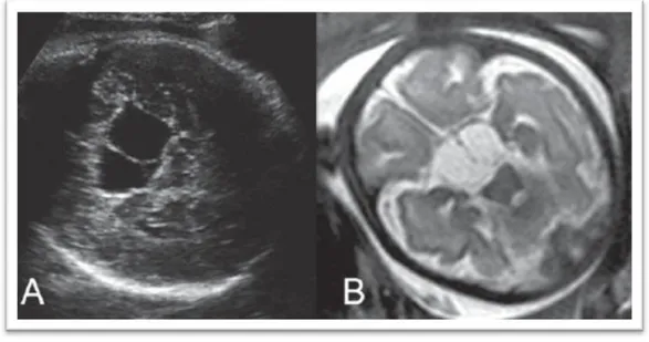 Figura 2 -  (A) Corte Axial de Ultrassonografia a nível do diâmetro biparietal. (B) Sequência T2 de Ressonância Magné- Magné-tica, com excelente contraste tecidual