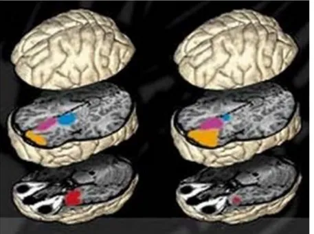 Figura 4 - Exemplificação da ativação encefálica de cérebro normal (à esquerda) e de sociopata (à direita) por RNMf