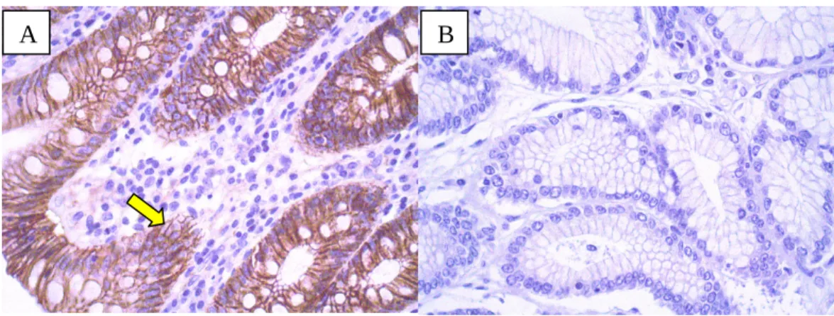 Figura 2- a)  β-catenina controle positivo, imunomarcação membranar em células  epiteliais  da  mucosa  intestinal;  b)  β-catenina  controle  negativo,  ausência  de  marcação em células epiteliais da mucosa intestinal (A, B: 400x)