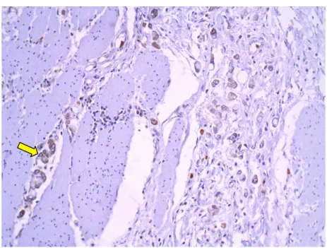 Figura 4 - Imunoexpressão positiva citoplasmática moderada de  LGR4 em células do tumor primário difuso (200x) 