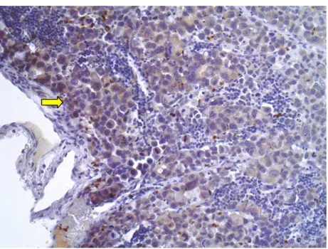 Figura 6 - Imunoexpressão positiva citoplasmática de LGR4 em  metástase linfonodal de células tumorais do tipo difuso (200x) 