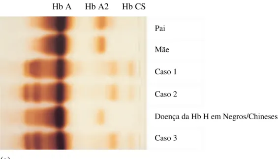Fig. 1.12 Hemoglobina Constant Spring (HbCS). (a) Electroforese em gel de amido da primeira família  identificada com esta perturbação, enviada aos autores pelo Dr Paul Milner