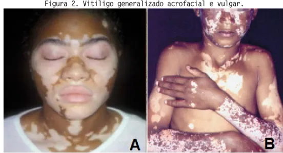 Figura 2. Vitiligo generalizado acrofacial e vulgar. 