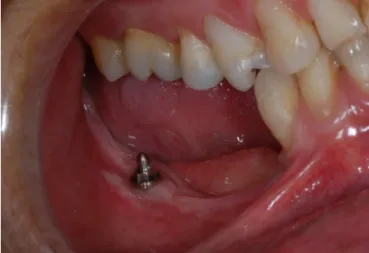 Figure 5 . Female component incorporated into the base of the removable partial  dentures.