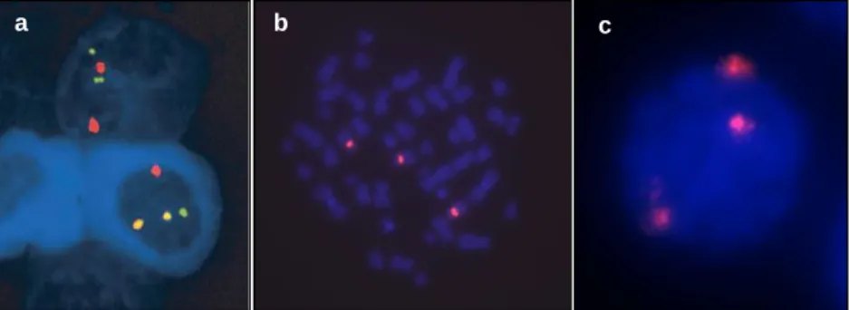 Figura 3.4. Exemplo de diferentes aplicações de FISH. (a) Deteção da transloção t(11;14) com sonda dual  color/dual  fusion  em  células-alvo  por  cig-FISH  em  Mieloma  Múltiplo;  (b)  Metáfase  e  (c)  interfase  com  trissomia do cromossoma 8 (sonda ce