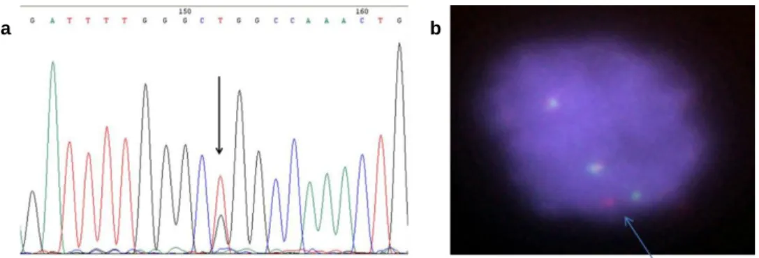 Figura  3.6.  Biomarcadores  em  CPNPC.  (a)  Eletroferograma  parcial  do  exão  21  do  gene  EGFR  com  a  mutação  pontual  c.2753C&gt;T;  p.(Leu858Arg)  (indicado  pela seta)