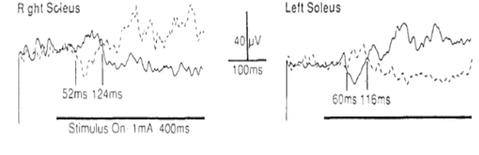 Figura 2 – Respostas eletromiográficas evocadas em resposta ao estímulo vestibular e captadas no músculo  soleus bilateralmente 