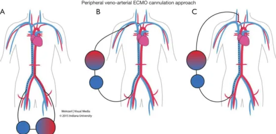 Figura 4 - Esquema do procedimento ECMO-VA  [24]   