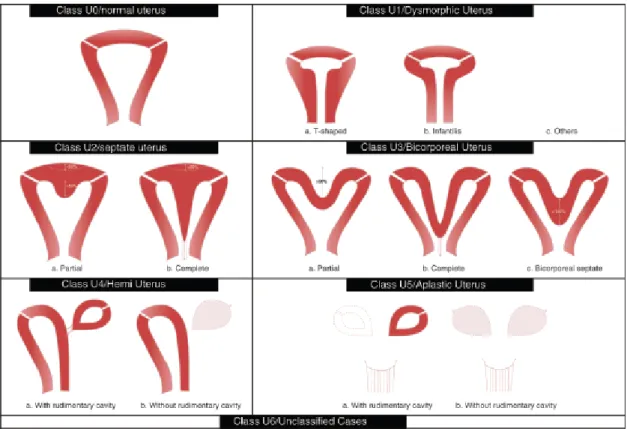 Figura 1. Classificação das anomalias congénitas do tracto genital feminino [8]