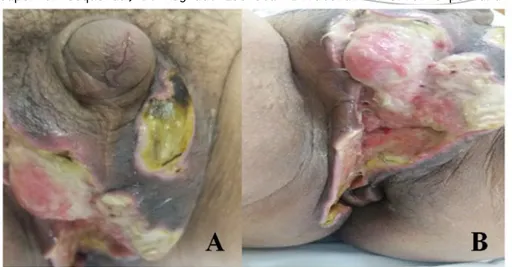 Figura 2: 12º dia curativo tópico.  Antes do tratamento de Câmara Hiperbárica (A: Região  Escrotal superior esquerda; B: Região: Escrotal Bilateral inferior e perianal direta)