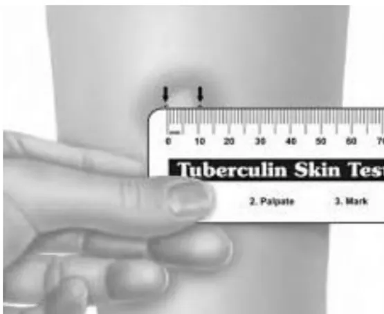 Figura 3 – Medição correcta do resultado do teste  da tuberculina  c)