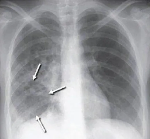 Figura 2 – Radiografia de um pulmão sugestivo  de tuberculose  b)