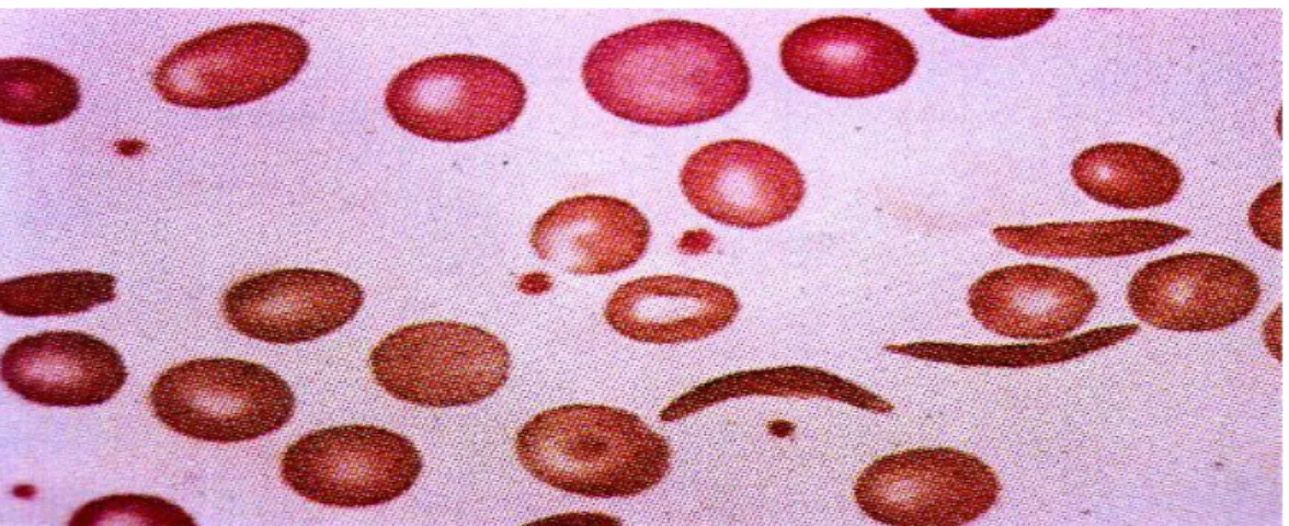 Figura 10. Esfregaço de sangue periférico de paciente com anemia falciforme. 