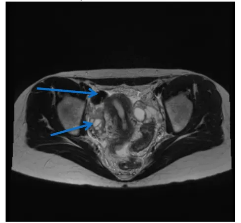 Figura 7 - Imagem de Ressonância magnética da pelve no plano axial ponderada em T2, demonstrando  focos de endometriose profunda com acometimento intestinal (seta)