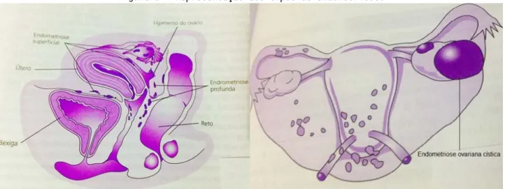 Figura 1 - Representação dos tipos de endometriose. 
