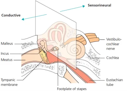 Figura 3. Distinção entre perda auditiva condutiva ou neurosensorial. (12)   