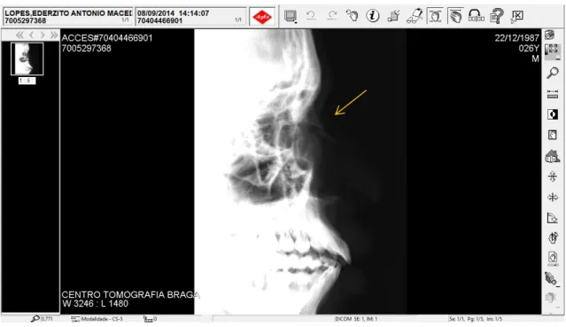 Ilustração 2 Afundamento dos ossos proprios do nariz, sem laterilazação. 