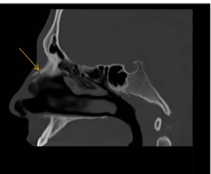 Ilustração 6 TC seios perinasais, plano sagital onde é visível fratura dos ossos próprios do nariz