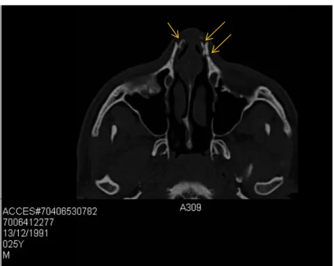 Ilustração 11 TC seios perinasais, corte axial, onde começam a ser visíveis as múltiplas fraturas