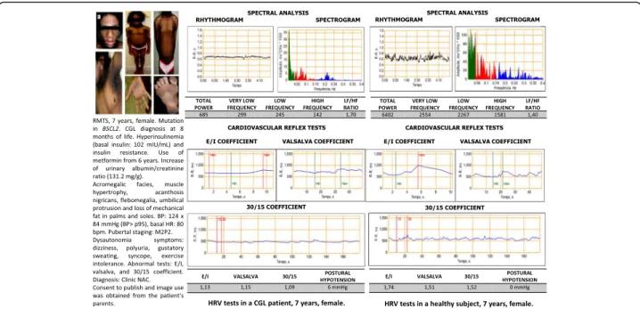 Fig. 1 Evaluation tests for the cardiac frequency variation in a patient with congenital generalized lipodystrophy and a healthy control