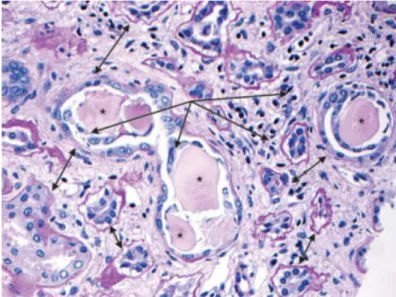 Figure  5- light microscopy of a kidney with cast nephropathy stained with  PAS,  with  characteristic  features  of  CN  marked