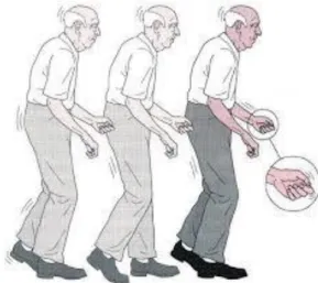 Figura 5: Postura curvada e tremor na doença de  Parkinson.