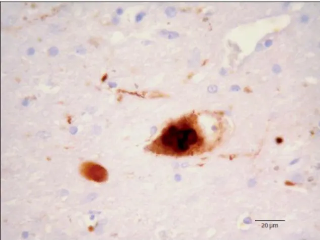 Figura  9:  Aglomerados  proteicos  de  α – Sinucleína  em  um neurônio da substância negra de um paciente com  Parkinson