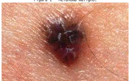 Figura 1 - Melanoma maligno. 