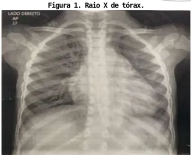 Figura 1. Raio X de tórax. 