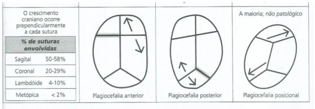 Figura 4-Plagiocefalias  