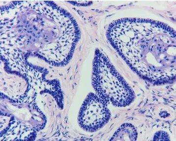 Figura 1: Fotomicrografia de ameloblastoma multicístico, variante folicular, mostrando células colunares  altas em paliçada na periferia e área central semelhante ao retículo estrelado do órgão do esmalte com  presença de degenerações císticas (H.E.; x200)