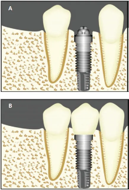 Figura 1 – (A) Imediatamente após a instalação do implante e (B) Imediatamente  após a colocação da prótese 