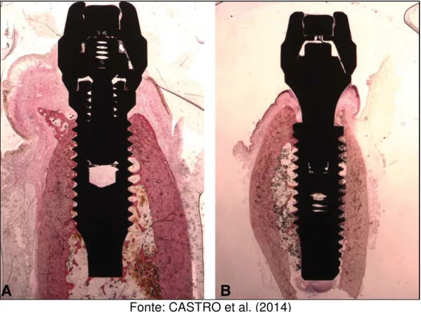 Figura 8 – Imagem radiológica com detalhes dos implantes, tecidos moles e osso  para conexão do tipo hexágono externo (A) e cone morse (B) 