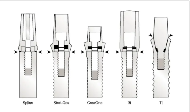 Figura 10 – Desenho esquemático contendo as geometrias dos 5 sistemas de  implantes estudados