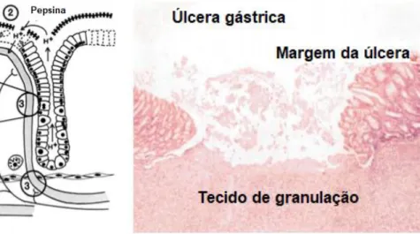 Figura 7 - Mecanismos de lesão e histologia da úlcera gástrica. (a) A lesão  da  mucosa  gástrica  aguda  resulta  em:  (1)  interrupção  da  camada  de  muco/bicarbonato  não  ativada  e  hidrofobicidade  superficial,  (2)  lesão  e  perda  do epitélio su
