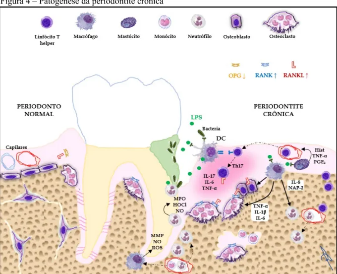 Figura 4 – Patogênese da periodontite crônica 