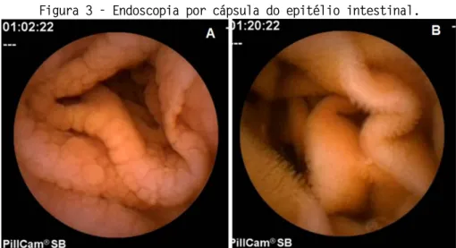 Figura 3 - Endoscopia por cápsula do epitélio intestinal. 