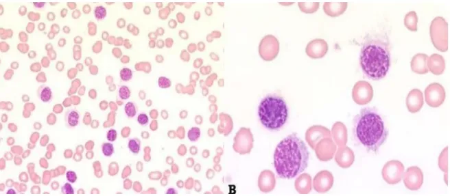 Figura 5 - Leucemia a tricoleucitos. (A) Linfocitose; (B) Linfócitos com projeções caraterísticas em leucemia por tricoleucócitos