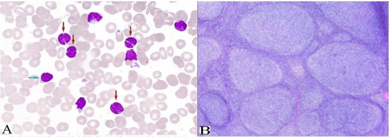 Figura 6 - Linfoma folicular; (A) Linfócitos tipicamente pequenos, com contorno nuclear, irregular e angular