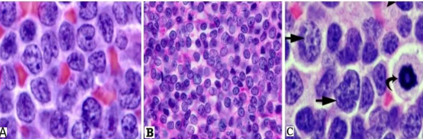 Figura 7 - Variantes histológicas do linfoma do manto (A) Variante típica, com núcleos arredondados irregulares